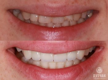 Керамічні реставрації 6